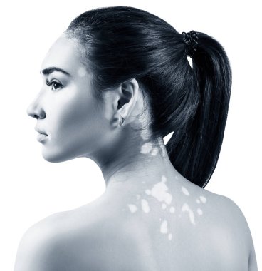 Vitiligo 'lu güzel bir kadının portresi.