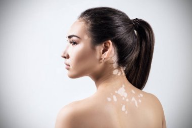 Vitiligo 'lu güzel bir kadının portresi.