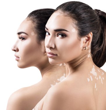 Vitiligo hastalığı olan güzel bir kadın kolajı..