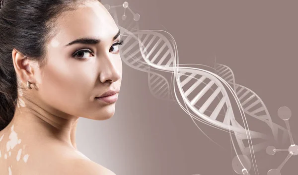 Jeune femme sensuelle avec la maladie du vitiligo dans les chaînes d'ADN — Photo