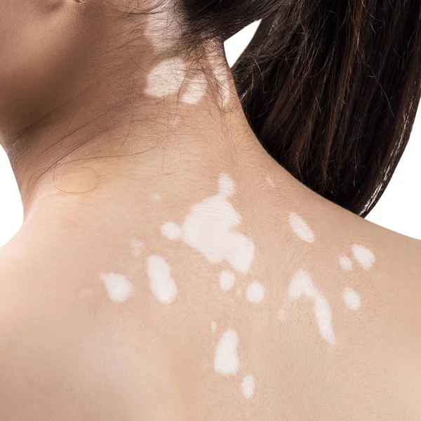 Achteraanzicht op vrouwelijke rug met vitiligo. — Stockfoto