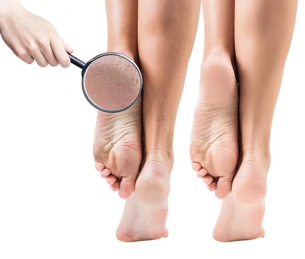Ноги с сухой кожей до и после процедуры . — стоковое фото