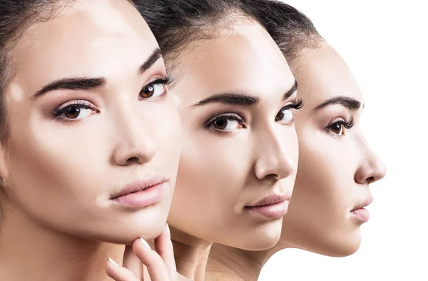 Collage de mujer hermosa con enfermedad de vitiligo . — Foto de Stock