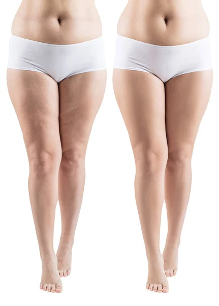 Woman legs before and after slimming. — Stock Photo, Image