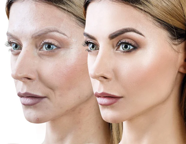 Woman before and after rejuvenation or plastic surgery. — Stock Photo, Image