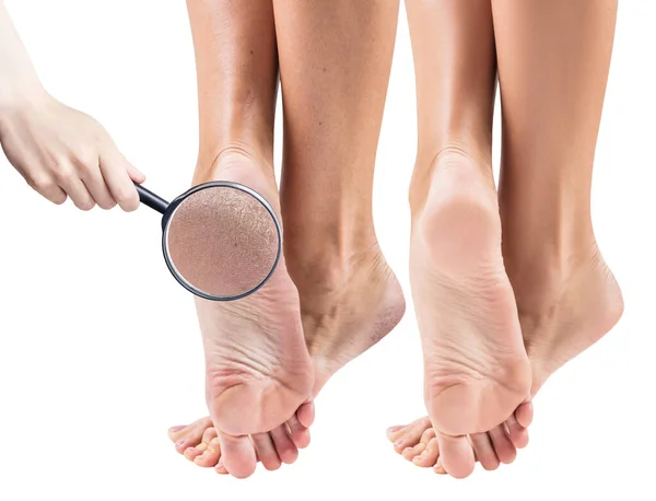 Stopy z suchą skórą, przed i po leczeniu. — Zdjęcie stockowe