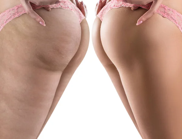 Vrouwelijke billen vóór en na de cellulitis. — Stockfoto