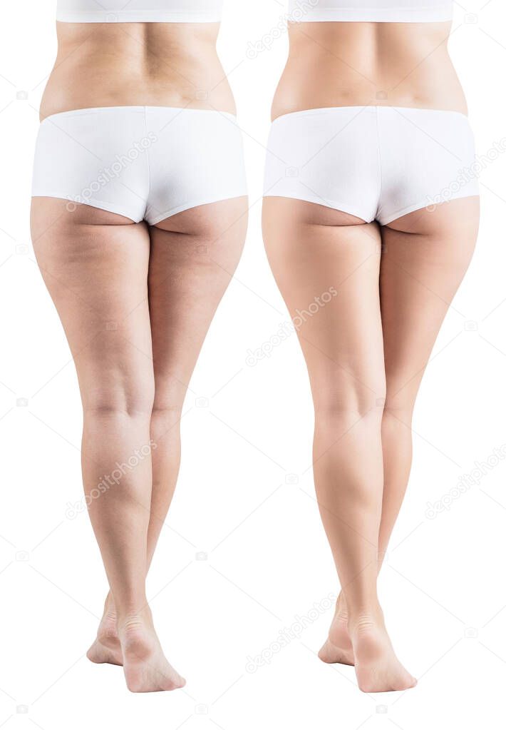 Fatty female buttocks before and after cellulitis