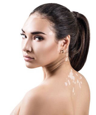 Vitiligo 'lu güzel bir kadının portresi.