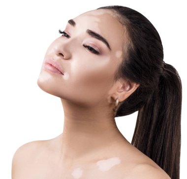 Vitiligo hastalığı olan şehvetli bir kadının portresi.