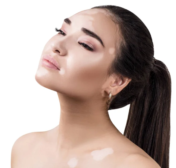 Portret van sensuele vrouw met vitiligo ziekte. — Stockfoto