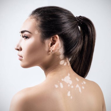 Vitiligo 'lu güzel bir kadının portresi.