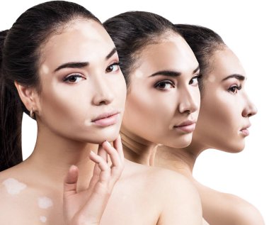 Vitiligo hastalığı olan güzel bir kadın kolajı..