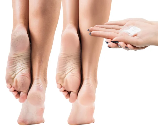 Stopy z suchą skórą, przed i po leczeniu. — Zdjęcie stockowe