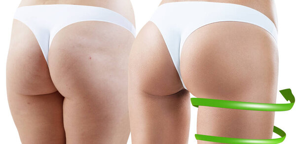 Big spiral arrows shows result of slimming on buttocks.