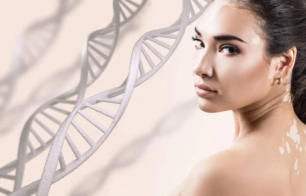 Mladá smyslná žena s vitiligem v řetězcích DNA. — Stock fotografie
