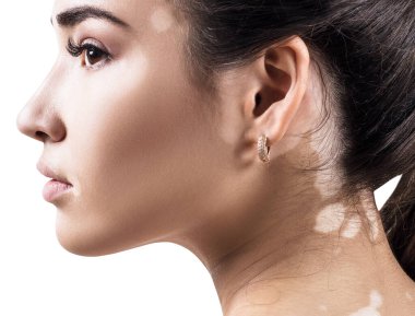 Vitiligo 'lu güzel bir kadının portresi.