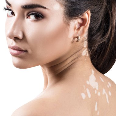 Vitiligo 'lu güzel bir kadının portresi.
