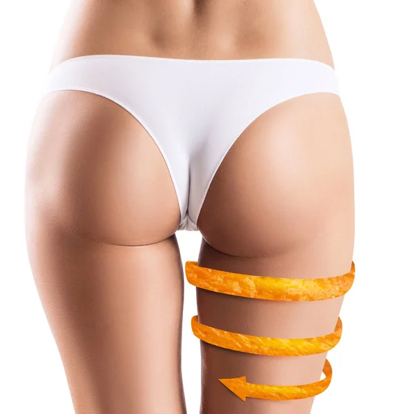 Female legs with orange peel arrow shows tightening effect. — Stock Photo, Image