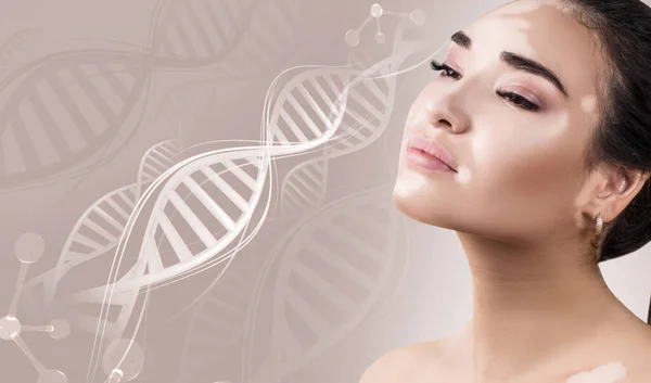 Mladá smyslná žena s vitiligovou chorobou v řetězcích DNA. — Stock fotografie