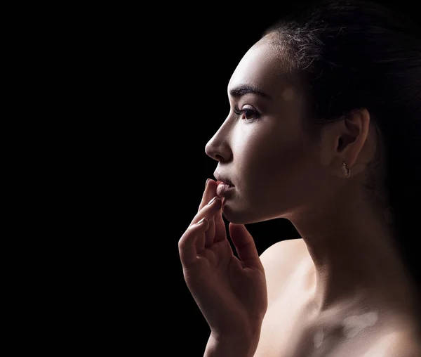 Portret van een mooie vrouw met vitiligo. — Stockfoto