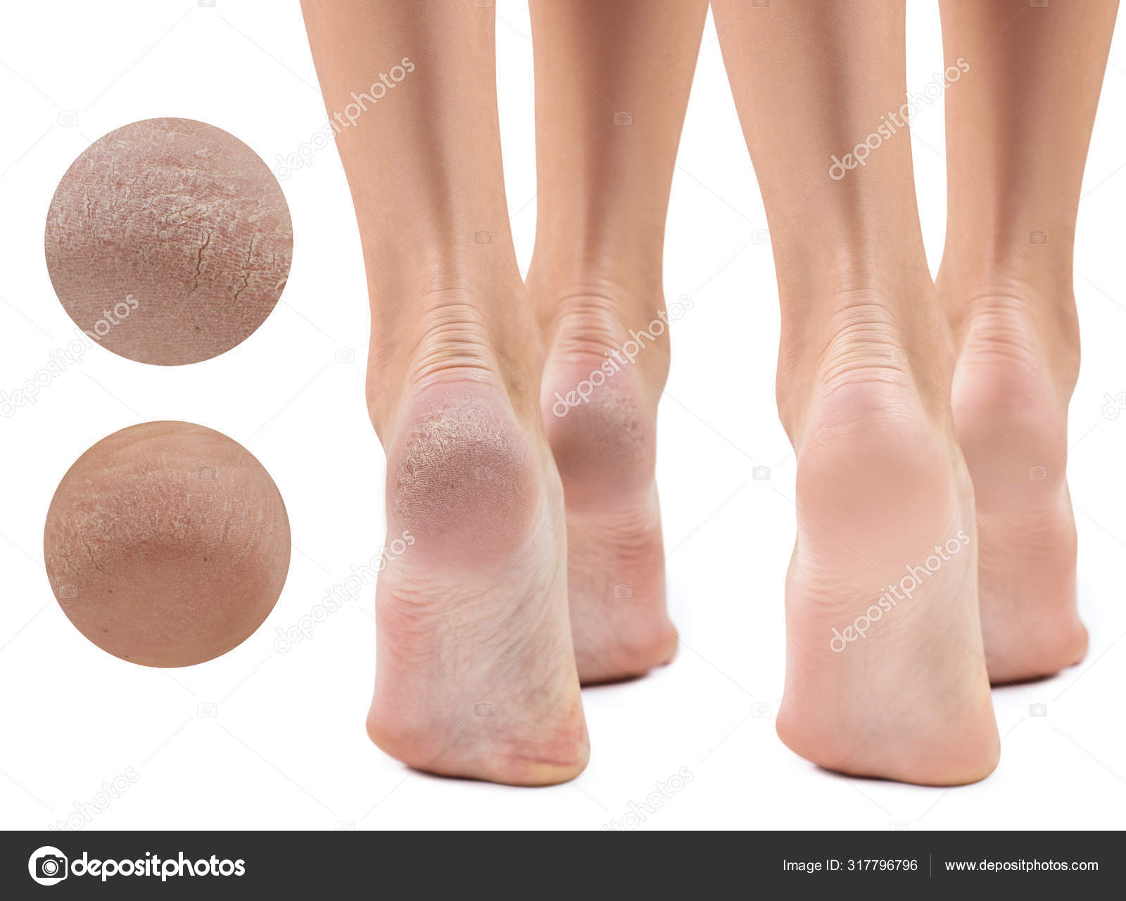 Почему сухие ноги. Почему сухие ноги. Почему сухие ноги. Бородавчатая эпидермофития. Фрамбезийный гиперкератоз.