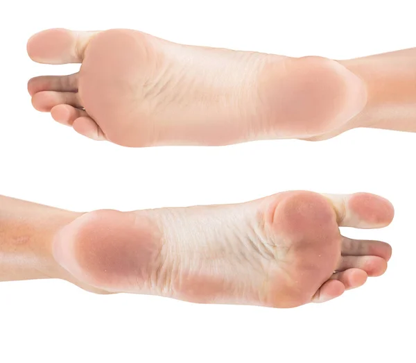 Fötter med torr hud före och efter behandling. — Stockfoto
