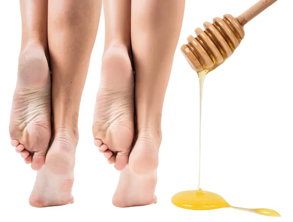 मध उपचारापूर्वी आणि नंतर कोरड्या त्वचेचे पाय . — स्टॉक फोटो, इमेज