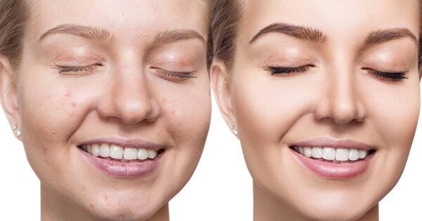 Young woman before and after skin treatment.