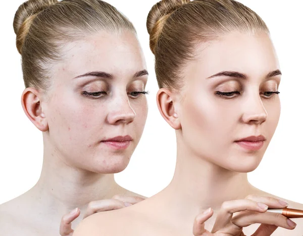 Mulher jovem antes e depois do tratamento da pele . — Fotografia de Stock