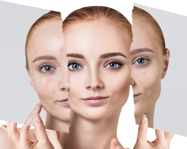 Comparar foto vieja con acné y piel sana nueva . —  Fotos de Stock