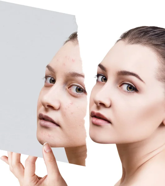 Compare of old photo with acne and new healthy skin. — Stock Photo, Image
