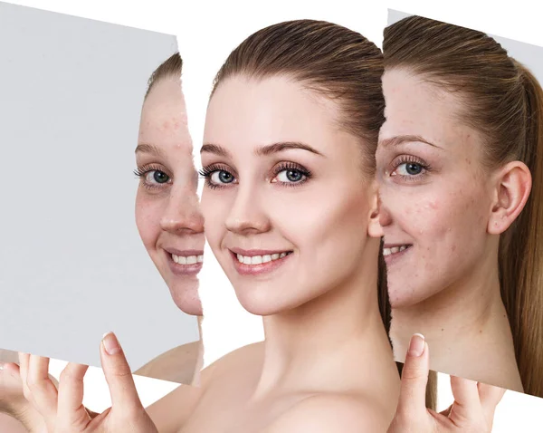 Compare of old photo with acne and new healthy skin. — Stock Photo, Image