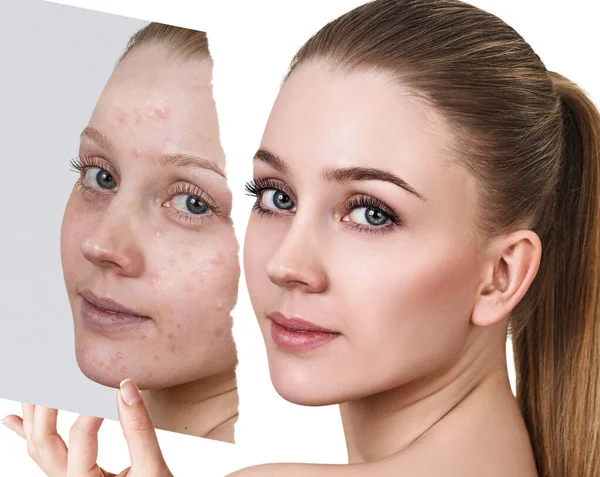 Compare of old photo with acne and new healthy skin. — Stock Photo, Image