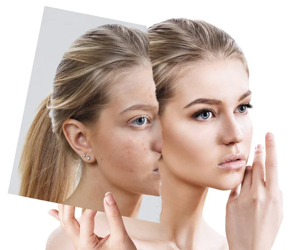 Comparer une vieille photo avec de l'acné et une nouvelle peau saine . — Photo
