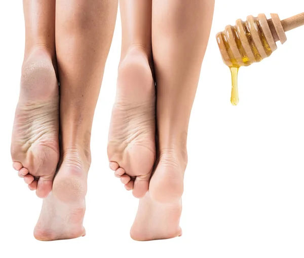 前と蜂蜜の治療後の乾燥肌の足. — ストック写真