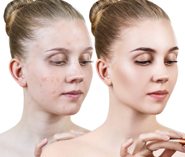 Giovane donna prima e dopo il trattamento della pelle . — Foto Stock