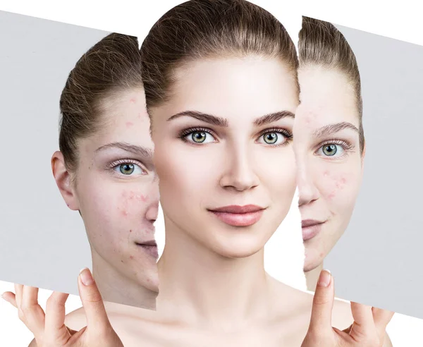 Confronto tra vecchia foto con acne e nuova pelle sana . — Foto Stock