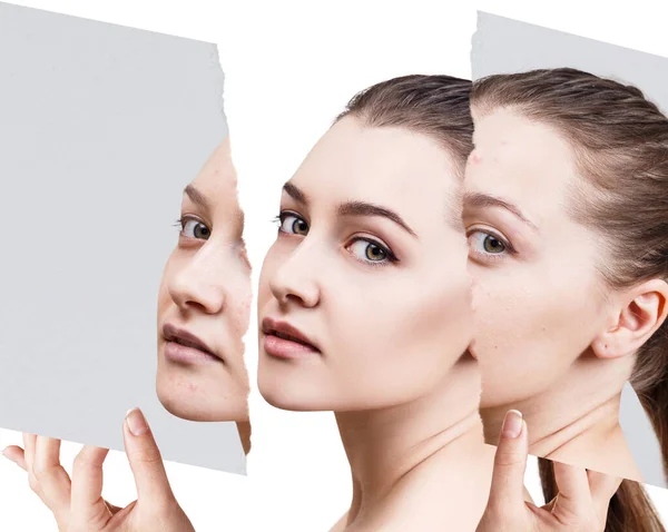 Comparar foto vieja con acné y piel sana nueva . —  Fotos de Stock