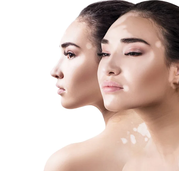 Collage van mooie vrouw met vitiligo ziekte. — Stockfoto