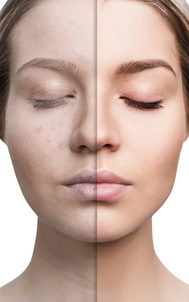 Woman with acne before and after treatment. — Stock Photo, Image