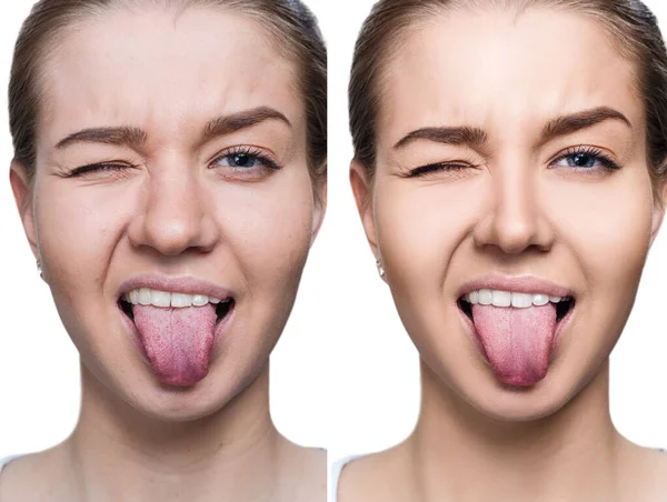 Young woman with acne before and after retouch. — Stock Photo, Image