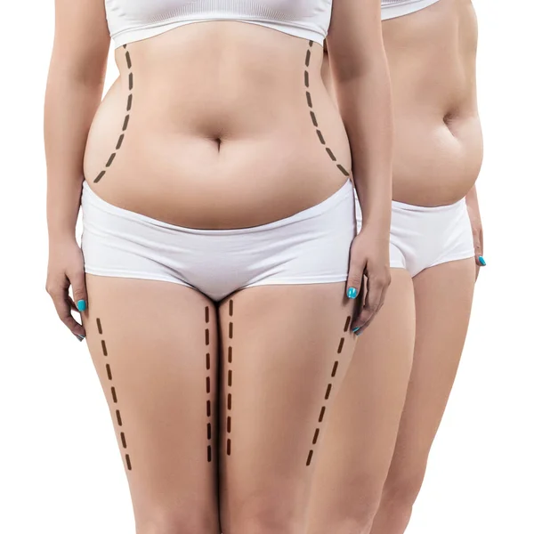 Fat woman with dotted lines on her body. — Stock Photo, Image