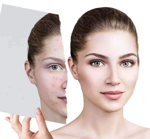 Compare of old photo with acne and new healthy skin. — Stock Photo, Image