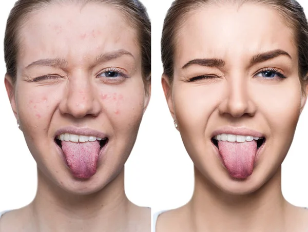 Woman with acne before and after treatment and make-up. — Stock Photo, Image