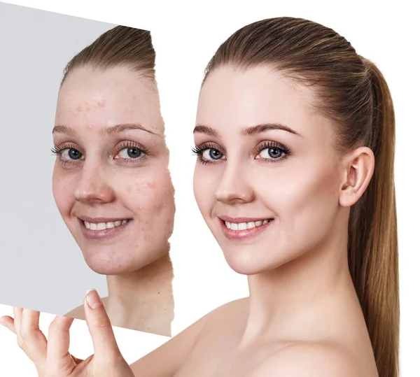 Compare of old photo with acne and new healthy skin. — Stock Photo, Image