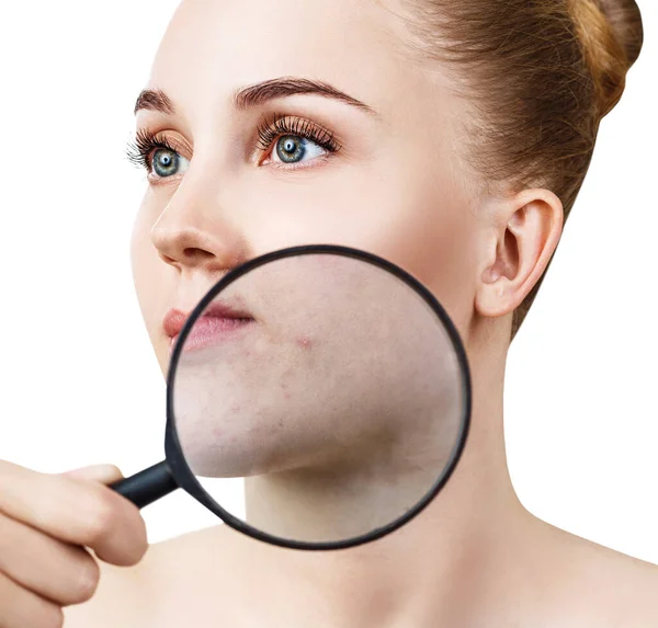 Young woman with magnifying glass shows skin with acne. — Stock Photo, Image