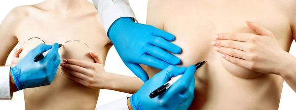 Γιατρός χέρι ζωγραφική διακεκομμένη γραμμή στο γυναικείο στήθος. — Φωτογραφία Αρχείου