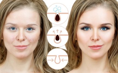 Grafiksel olarak yüz gözenekleri kirletmek ve temizlemek için nasıl gösterir.