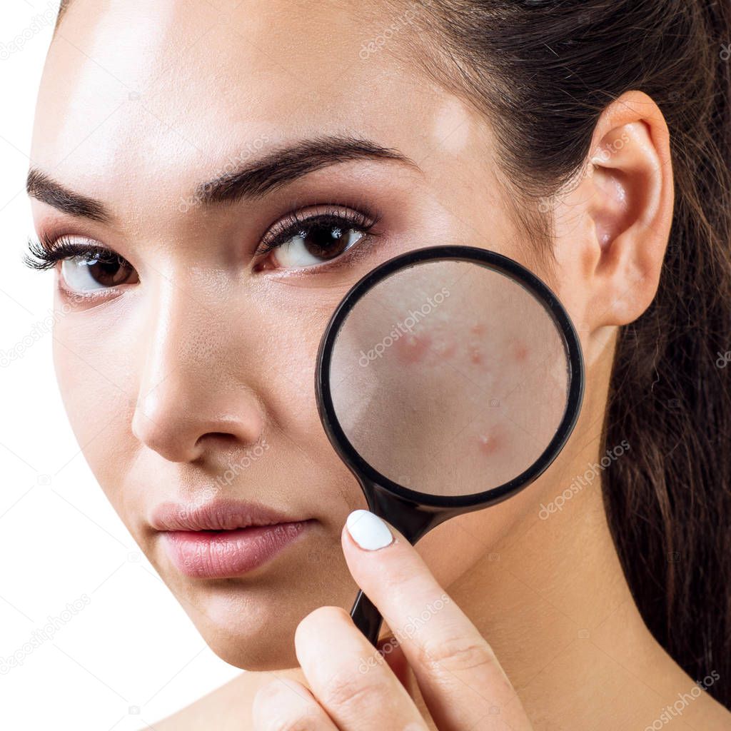 Young woman with magnifying glass shows skin with acne.